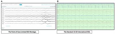 Adult Critical Care Electroencephalography Monitoring for Seizures: A Narrative Review